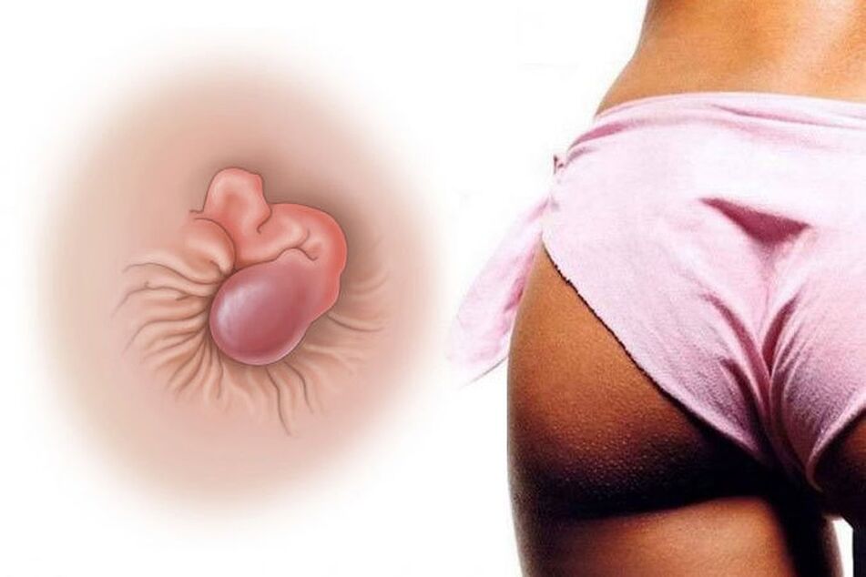 Natierleche Crème geheien hemorrhoiden an engem Cours