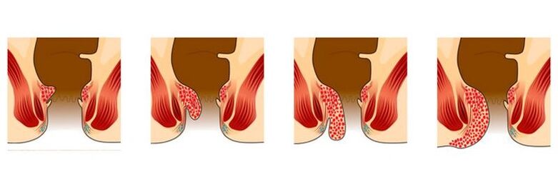 D'Etappe vun der Entwécklung vun der Hemorrhoiden